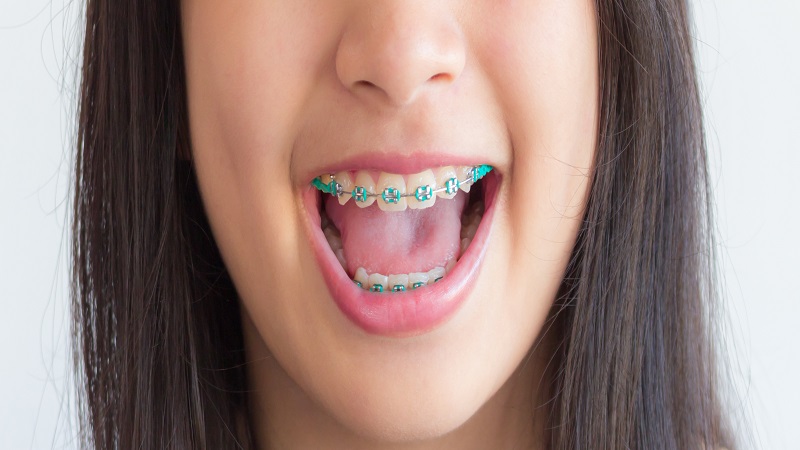 ارتودنسی رنگی | متخصص دندانپزشک کودکان کاشان