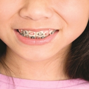 ارتودنسی رنگی | متخصص دندانپزشک کودکان کاشان