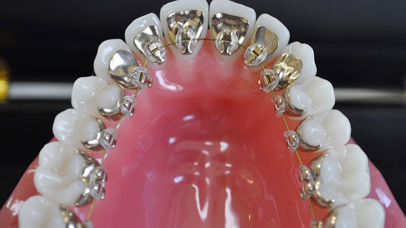 ارتودنسی لینگوال ( ارتودنسی نامرئی ) | متخصص دندانپزشک کودکان کاشان