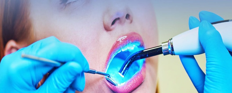 کشیدن دندان با لیزر | متخصص دندانپزشک کودکان کاشان