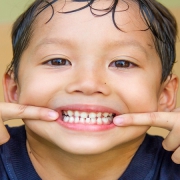 لکه سفید روی دندان کودکان | متخصص دندانپزشک کودکان کاشان