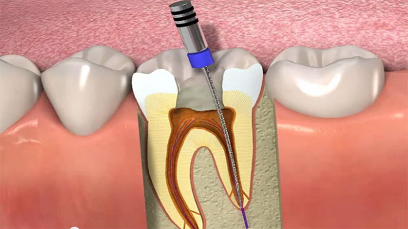 علل عصب کشی دندان چیست؟ | متخصص دندانپزشک کودکان کاشان