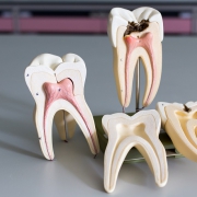 نحوه انجام عصب کشی دندان | متخصص دندانپزشک کودکان کاشان