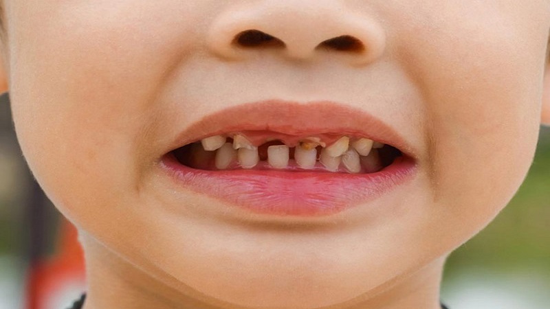 تروما چیست؟ | متخصص دندانپزشک کودکان کاشان