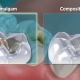 تفاوت آمالگام و کامپوزیت | متخصص دندانپزشک کودکان کاشان