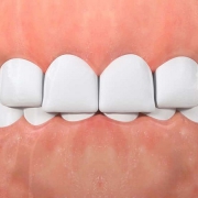 ديپ بايت (Deep Bite) چیست؟ | متخصص دندانپزشک کودکان کاشان