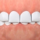 ديپ بايت (Deep Bite) چیست؟ | متخصص دندانپزشک کودکان کاشان