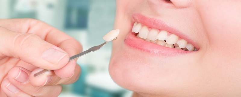 مزایا و معایب ونیر دندان | متخصص دندانپزشک کودکان کاشان