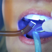 مزایای کامپوزیت دندان | متخصص دندانپزشک کودکان کاشان