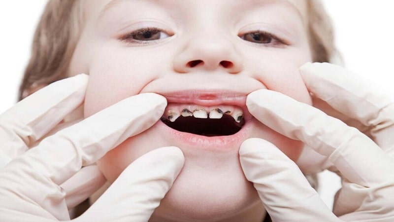 مصرف شیر و پوسیدگی در دندان کودک | متخصص دندانپزشک کودکان کاشان