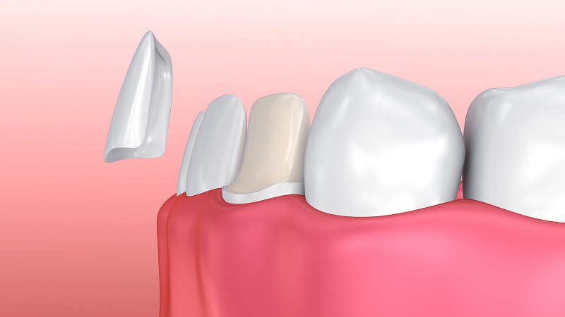 ونیرهای دندان چیست؟ | متخصص دندانپزشک کودکان کاشان