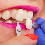 ونیرهای دندان چیست؟ | متخصص دندانپزشک کودکان کاشان