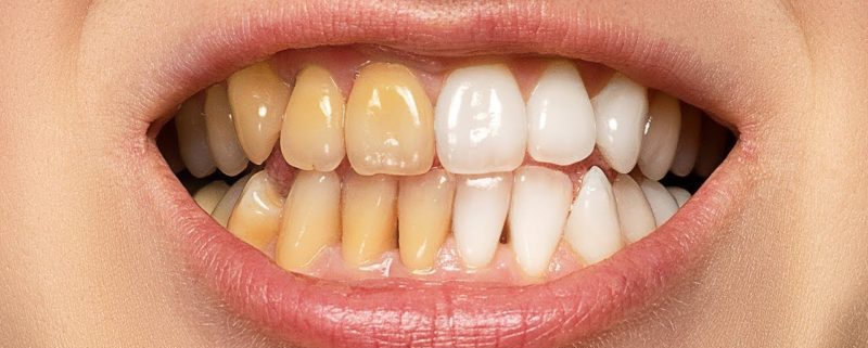 روش‌های درمانی تغییر رنگ دندان‌ها | متخصص دندانپزشک کودکان کاشان