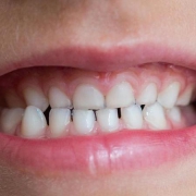 قطره آهن و پوسیدگی دندانی | متخصص دندانپزشک کودکان کاشان