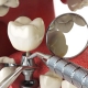 مراحل و کاربردهای پیوند دندان | متخصص دندانپزشک کودکان کاشان