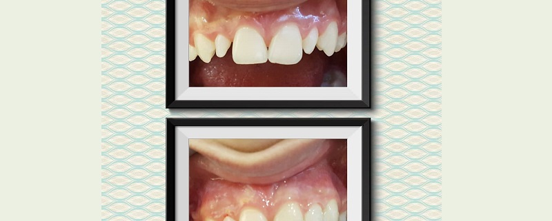 ترمیم زیبایی دندانهای قدامی در یک نوجوان | متخصص دندانپزشک کودکان کاشان