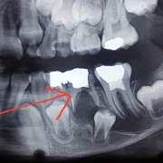 درمان نادرست عصب یک دندان شیری | متخصص دندانپزشک کودکان کاشان