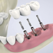 عوارض دائمی کاشت ایمپلنت | متخصص دندانپزشک کودکان کاشان