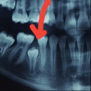 عوارض کشیدن زودهنگام دندان شیری | متخصص دندانپزشک کودکان کاشان