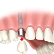 مزایا و معایب پیوند دندان | متخصص دندانپزشک کودکان کاشان