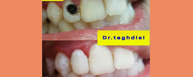 نمونه عمل ترمیم دندان دکتر تقدیسی | متخصص دندانپزشک کودکان کاشان