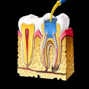 خطرات و عوارض عصب کشی دندان | متخصص دندانپزشک کودکان کاشان