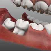 علل و علائم خرد شدن دندان های عقل | متخصص دندانپزشک کودکان کاشان