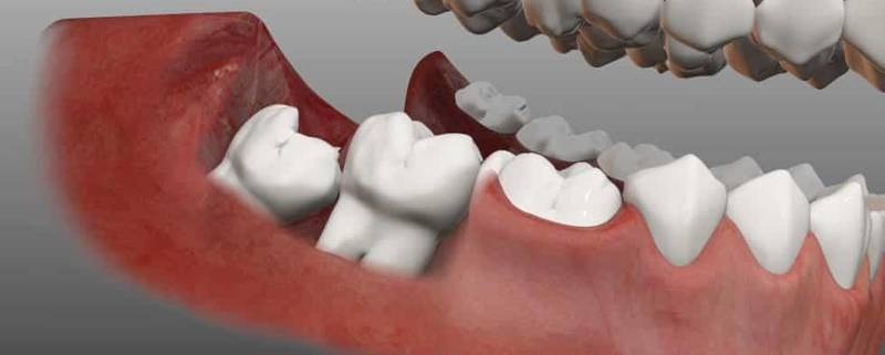 علل و علائم خرد شدن دندان های عقل | متخصص دندانپزشک کودکان کاشان