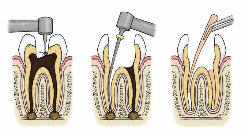 مراقبت‌های پس از عصب کشی دندان | متخصص دندانپزشک کودکان کاشان
