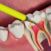 مراقبت‌های پس از عصب کشی دندان | متخصص دندانپزشک کودکان کاشان