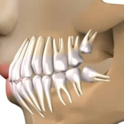 بررسی انواع نهفتگی دندان های عقل | متخصص دندانپزشک کودکان کاشان