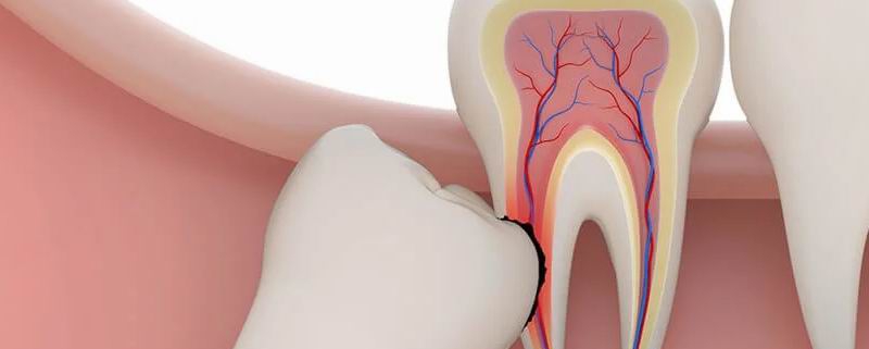علل و علائم مشکلات دندان عقل چیست؟ | متخصص دندانپزشک کودکان کاشان