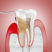 بررسی علت و علائم ایجاد پری کورونیت دندان | متخصص دندانپزشک کودکان کاشان