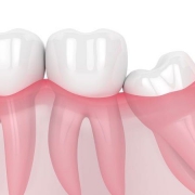 روش های درمانی نهفتگی دندان عقل | متخصص دندانپزشک کودکان کاشان