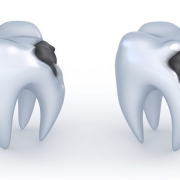 علت سیاه شدن داخل دندان شکسته چیست؟ | متخصص دندانپزشک کودکان کاشان