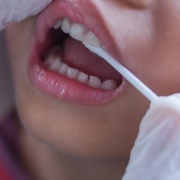 علت و علائم فلوئوروزیس دندانی چیست؟ | متخصص دندانپزشک کودکان کاشان