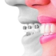 ارتودنسی یا کامپوزیت دندان بهتر است؟ | متخصص دندانپزشک کودکان کاشان