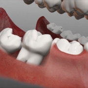 عوامل و انواع مال اکلوژن دندان | متخصص دندانپزشک کودکان کاشان