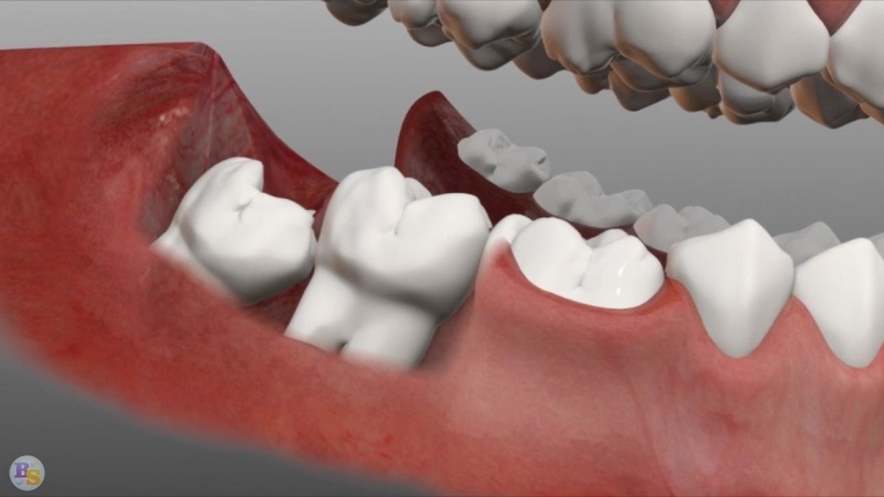 عوامل و انواع مال اکلوژن دندان | متخصص دندانپزشک کودکان کاشان