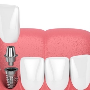معایب ایمپلنت بدون جراحی چیست؟ | متخصص دندانپزشک کودکان کاشان