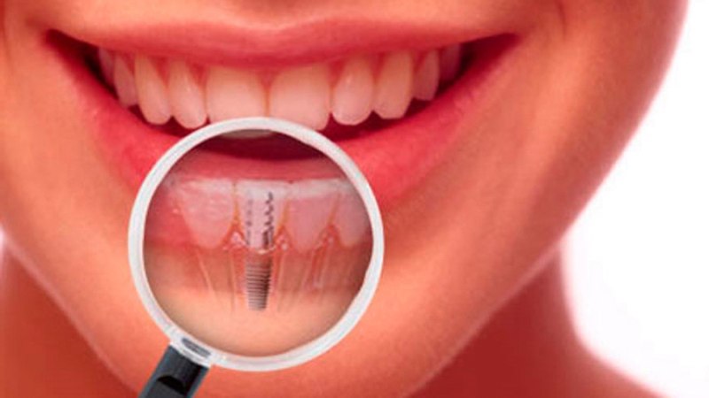 معایب ایمپلنت بدون جراحی چیست؟ | متخصص دندانپزشک کودکان کاشان