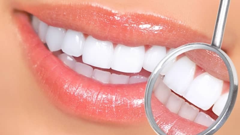 مقایسه بلیچینگ با جرمگیری دندان | متخصص دندانپزشک کودکان کاشان
