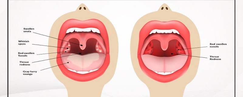 علل ایجاد لکه های قرمز در دهان | متخصص دندانپزشک کودکان کاشان
