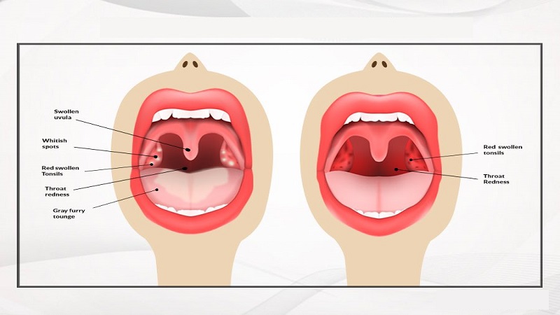 علل ایجاد لکه های قرمز در دهان | متخصص دندانپزشک کودکان کاشان